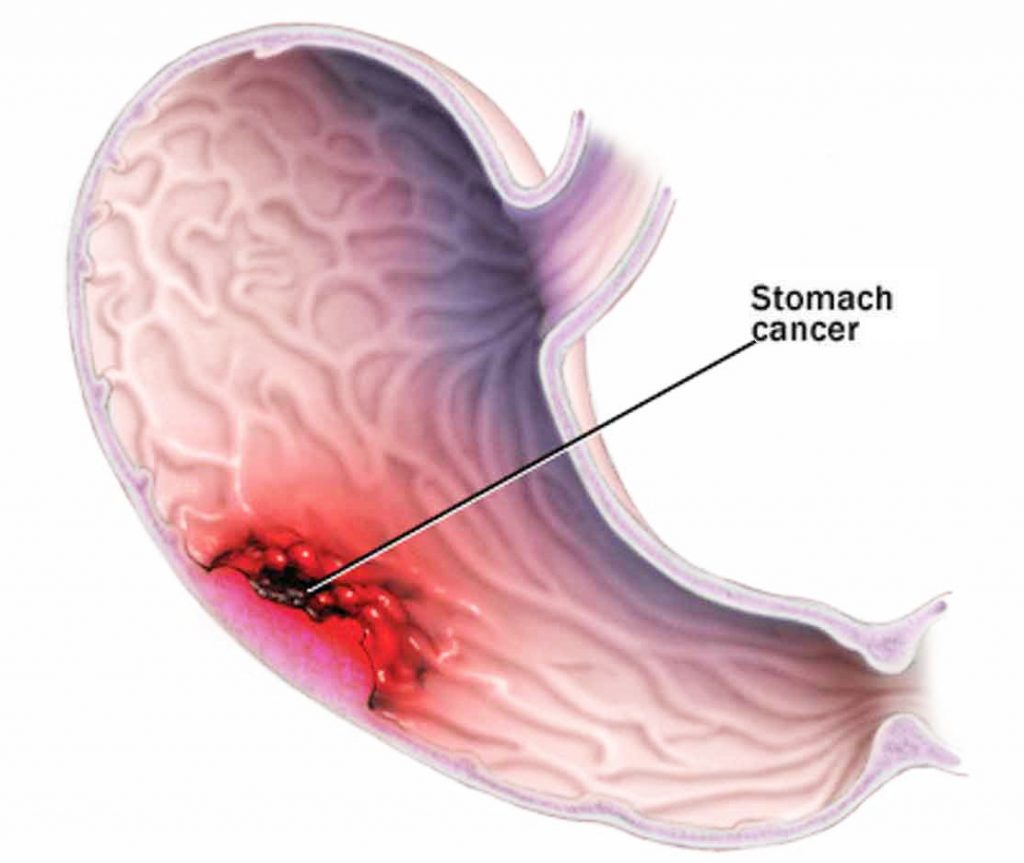 Factores De Riesgo Para El Cancer Gastrico Helicobacter Pylori