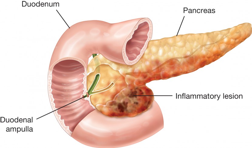 Inflamación del páncreas