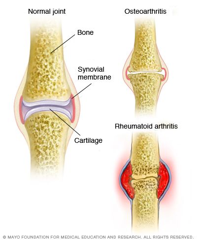 Comparación entre un cartílago normal, osteoartritis y artritis reumatoide.