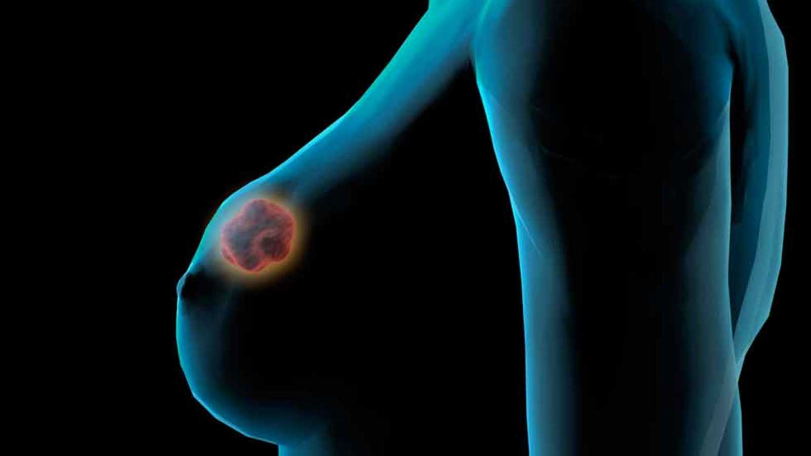 Cancer de mama vs nódulos benignos