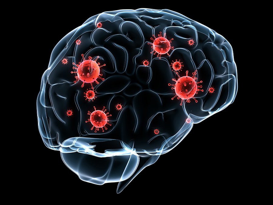Cuando los astrocitos son atacados se hace posible la metástasis cerebral