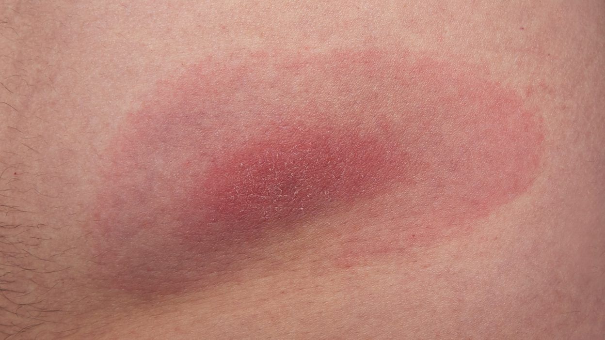 ¿Qué Es La Enfermedad De Lyme Y Dónde Está Aumentando Su Incidencia ¿Qué Es La Enfermedad De Lyme Y Dónde Está Aumentando Su Incidencia