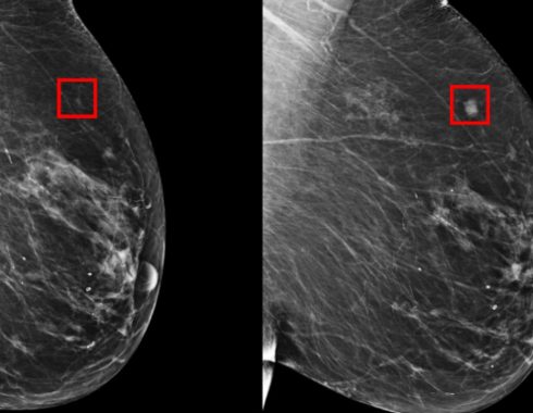 MIT dispositivo cancer de mama