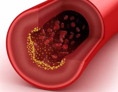 Hallan niveles inquietantes de "colesterol feo" en la sangre