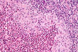 Histiocitosis de células de Langerhans