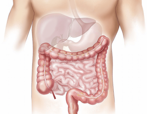 Cáncer de colon: síntomas y tratamiento