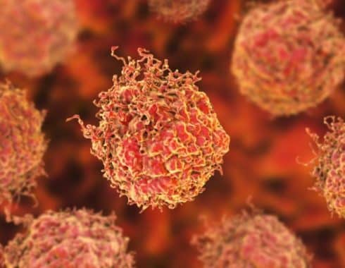 Células tumorales prostáticas se relacionan con la agresividad del cáncer
