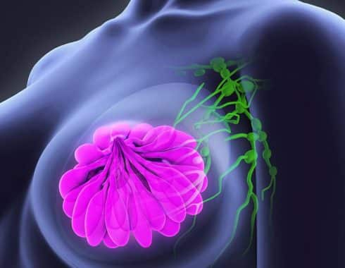 Posible método para tratar tumores de mama