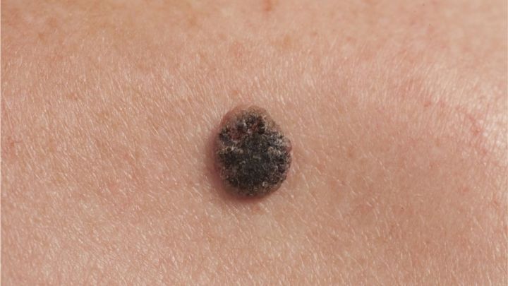 La mayoría de melanomas se desarrollan en una nueva marca corporal 