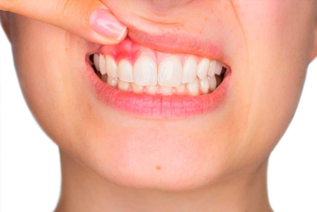 Cepillarse no basta contra la enfermedad periodontal