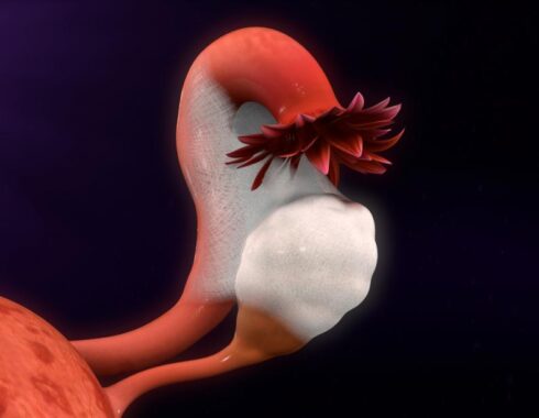 Endometriosis: un diagnóstico difícil
